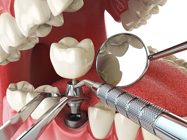 Best Emergency Dental Care for Broken or Chipped Teeth in Dunnstown, PA